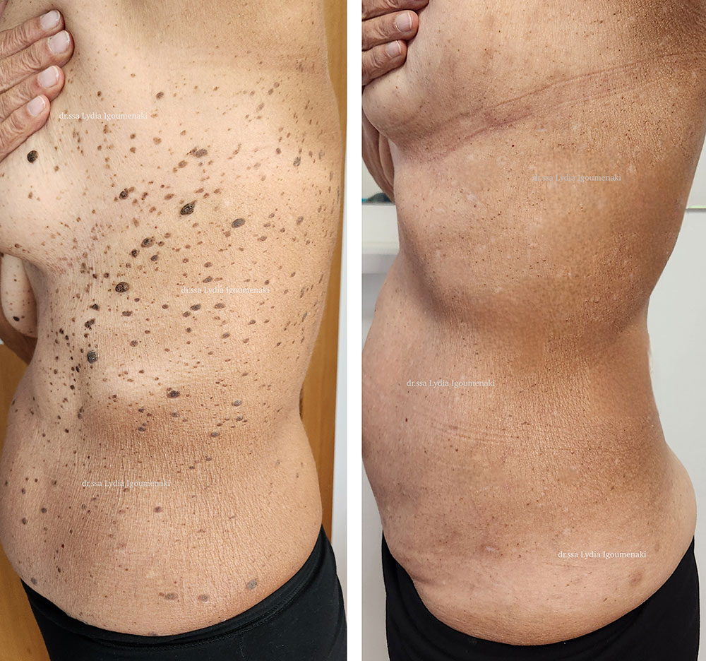 come-eliminare-cheratosi-e-macchie-dal-corpo