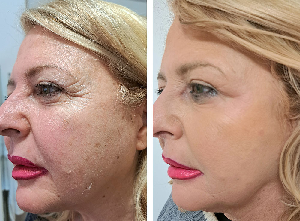 perche-scegliere-il-peeling-chimico-a-roma-con-la-dr-ssa-lydia-igoumenaki